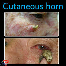 Image result for cornu cutaneum)