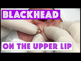 Vassoul blackhead remover suction black mask amazon.com. Best Dr Pimple Popper Blackhead Extraction Videos Ever