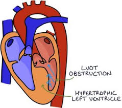 Image result for Left Ventricular Outflow Obstruction