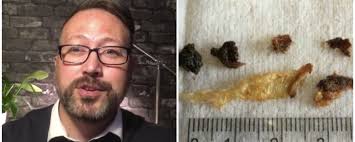 There is a non functioning tube crusted over with earwax. We Talked To The Guy Behind Youtube S Most Satisfying Earwax Removal Videos