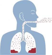 As more people develop mesothelioma after years of deadly exposure to asbestos, victims are teaming up with aggressive lawyers to file lawsuits against the … Asbestosis Is Incurable Lung Disease Caused By Asbestos Exposure