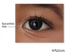Epicanthal folds are skin folds that may cover the inside corners of the eye. Eye And Vision Issues In Noonan Syndrome Noonan Syndrome Awareness Association