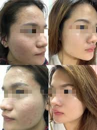 Research from the 1970s meets modern self-care with cryotherapy