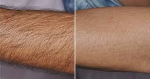 Check out our great #hairremoval treatments, from #waxing to laser hair removal to #tanning. Laser Hair Removal Training Course With Certification In Canada The Style Academy Regina Saskatchewan Canada