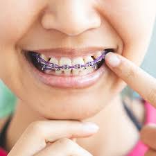 What to eat with braces for dinner. 9 Foods You Can Eat With Braces
