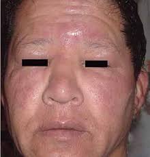 A scurfy, mealy substance on the surface of some plants. Aspecto De Facies Leonina En Paciente Con Lepra Dimorfa Lepromatosa Al Download Scientific Diagram