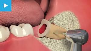 If the dentist sees an impacted wisdom tooth,. Wisdom Teeth Southfields Southfields Dental Centre