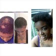 However, there are some home remedies that may help. Virgin Hair Fertilizer Before And After Cromalinsupport