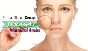 Faktor risiko dan punca botak bertompok @ alopecia areata. Kenapa Jeragat Terjadi Sampai Muka Bertompok Gelap Ohcantik Com