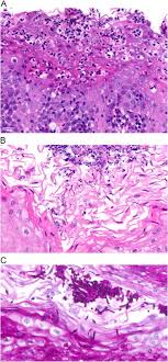 There is apparently a word for heartburn in sumerian. Non Reflux Esophagitis A Review Of Inflammatory Diseases Of The Esophagus Exclusive Of Reflux Esophagitis Sciencedirect