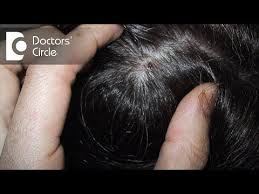 Image result for dry scabs on the head in children