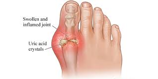 Image result for uric acid images hd free