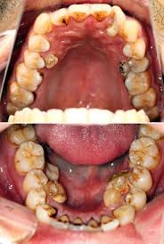 supernumerary teeth chart twoj doktor