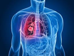 Learn the signs and symptoms of mesothelioma. What Are The Symptoms Of The Final Stages Of Lung Cancer Lung Cancer Lawsuit Lawyers Pintas Mullins Law Firm