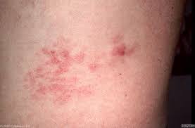 Cutaneous T Cell Lymphoma Symptoms Lymphoma T Cell Lymphoma Awareness