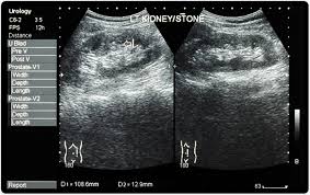Kidney Stones Symptoms And Causes
