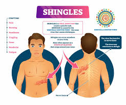 Image result for shingles
