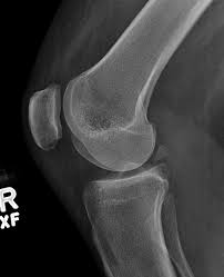 Image result for Knee XRay