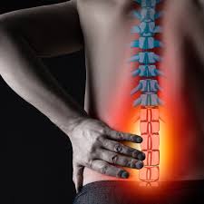 Image result for Sciatica