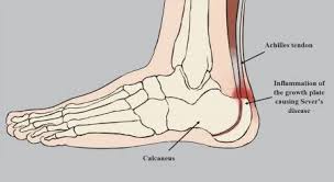 Image result for Calcaneal Apophysitis