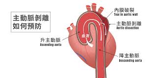主動脈剝離（英語：aortic dissection；法語：dissection aortique；德語：aortendissektion），又譯為主動脈夾層或心血管動脈剝離，是因為主動脈血管內膜（英語：tunica for faster navigation, this iframe is preloading the wikiwand page for 主動脈剝離. ä¸»å‹•è„ˆå‰é›¢å¦‚ä½•é é˜² Dcnhc
