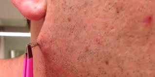 You may be more likely to get. Yes You Could Have An Ingrown Hair This Bad On Your Bikini Line