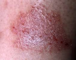 Image result for Eczema nummulare