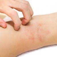 Some may appear in small patches on the body, and others may spread across a a rash is defined as a widespread eruption of skin lesions. Alcohol Allergy Causes And Symptoms Alcohol Rehab Guide