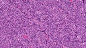 Carcinoma definition, a malignant and invasive epithelial tumor that spreads by metastasis and often recurs after excision; Non Keratinizing Squamous Cell Carcinoma Of The Tonsils And Base Of Tongue Mypathologyreport Ca
