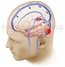 Idiopathic intracranial hypertension is a neurological condition characterised by increase in intracranial pressure likely due to obstruction in venous drainage without the evidence of a mass, lesion or hydrocephalus. Idiopathic Intracranial Hypertension New York Ny Spinal Fluid Shunt New York Ny