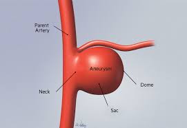Brain Aneurysm Basics Brain Aneurysm Foundation A brain aneurysm is a bulge in an artery in the brain.