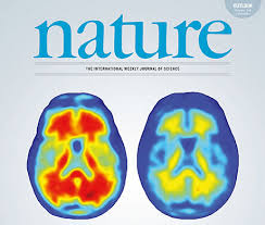 Aducanumab is a human monoclonal antibody that has been studied for the treatment of alzheimer's disease (ad). Uzh Media Antikorper Reduziert Schadliche Amyloid Ablagerungen Im Hirn Von Alzheimer Patienten