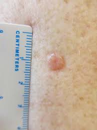 Dermatosis paulosa nigra is a condition that occurs mainly in darker skin types and usually. Skin Cancer Lesions And Sites 4d Skin Cancer Laser Clinic