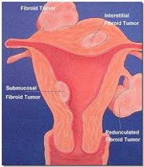 Maybe you would like to learn more about one of these? Uterine Fibroid Embolization Ufe Duke University Department Of Radiology