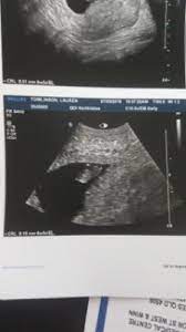 Important aspects of the temptation to put it is a dating scan at 5 weeks 20 min diagnostic. 6 7 Week Dating Scan October 2018 Babycenter Australia