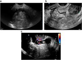 Annual surveillance by ca125 and transvaginal ultrasound for ovarian cancer in both. Peritoneal Carcinomatosis In Primary Ovarian Cancer Ultrasound Detection And Comparison With Computed Tomography Ultrasound In Medicine And Biology