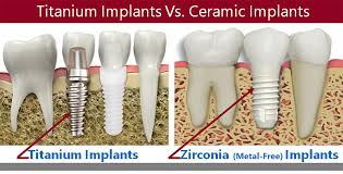 If your mouth is healthy enough for dental implants, then there's a good chance that cdg will accept you as a candidate. Metal Free Zirconia Implants Aria Dental Mission Viejo Ca