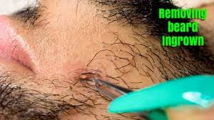 The grim effect of ingrown hair is cyst/pimple growth. Asmr Upclose Zoom Removing Ingrown Hair From Beard Moustache Youtube