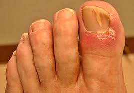 toe nail fungus