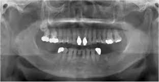 It is assumed that osteosarcomas of the jaws mainly occur at older ages, whereas the most prominent sites, that is, the long bones, are more affected at ages <20. A Modified Preauricular And Transmandibular Approach For Surgical Management Of Osteosarcoma Of The Mandibular Condyle Within The Masticator Space And Infratemporal Fossa A Case Report Journal Of Medical Case Reports