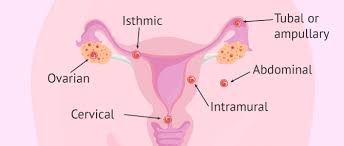 An ectopic pregnancy occurs when a fertilized egg implants and grows outside the main cavity of the uterus. What Causes An Ectopic Pregnancy Symptoms Diagnosis Treatment