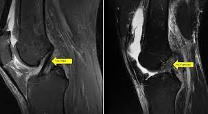 Acl & bone bruise • case 2: Where Is The Acl Missoula Bone Joint