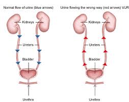Vesicoureteral Reflux I Have That And I Gave It To Niamh Too Pediatric Nursing Nursing Mnemonics Medical Problems