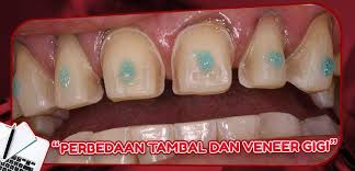 Jenis gigi berlubang yang bisa ditambal. Perbedaan Tambal Dan Veneer Dental Universe Indonesia