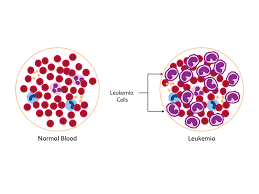 Most of these cancers start in your bone marrow where blood is produced. What Is Leukemia Types Of Leukemia Leukemia Causes
