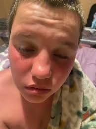 Poor Caiden is miserable … so for the about a year now Caidens face has  been getting really red and burning so bad even when he is just laying in  bed… we