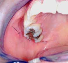 The parotid duct, or stenson duct, is the major duct of the parotid gland, which is the major doctor vs, rafii a, enepekides dj, tollefson tt. Congenital Unilateral Agenesis Of The Parotid Gland A Case Report And Review Of The Literature