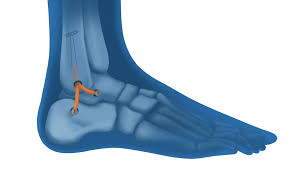 Les ligaments supportent également l'extrémité inférieure de la jambe. Ligamentoplastie De Cheville A Lyon