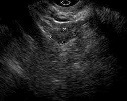 If a male sonographer is doing the scan, there will need to be a female . Imaging Of The Female Pelvis Through The Life Cycle Radiographics