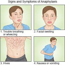 Image result for Anaphylaxis